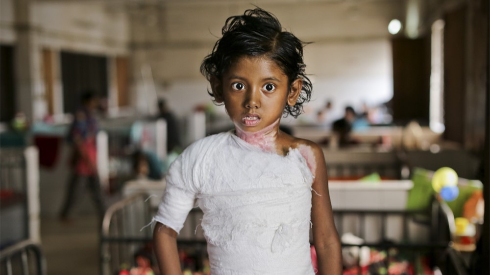 65 Burn Victim Saved by Desun Burn Victim Hospital Impact Story