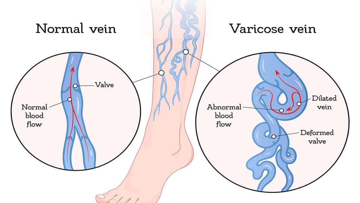Varicose Veins Definition Symptoms Causes Precautions Diagnosis